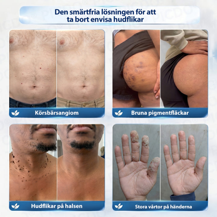 Picdo® 7-dagars hudförnyelsecykel – Smärtfri & Ärrfri – Avancerad Roll-on-penna mot Skavanker